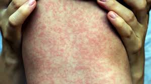 Ontario baby dies after being born prematurely with measles, other complications